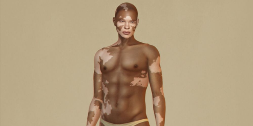 A Sim with custom vitiligo spots standing in their underwear